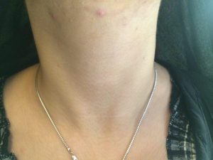 thyroid-surgery جراحی تیروئید