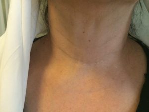 thyroid-surgery جراحی تیروئید