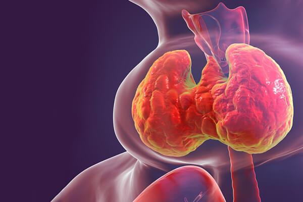 Goiter en