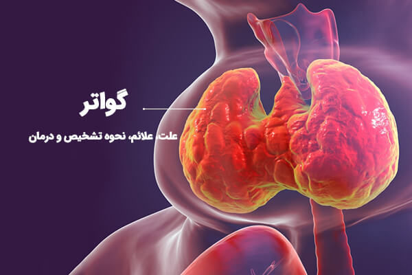 Goiter