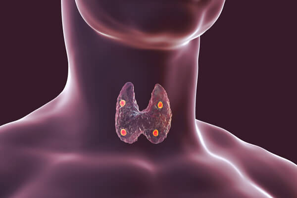 Hyperparathyroidism en