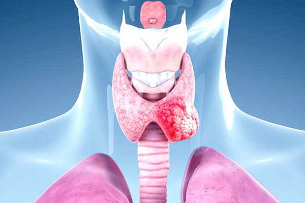 سرطان فولیکولار تیروئید چیست؟ علائم، تشخیص و نحوه درمان
