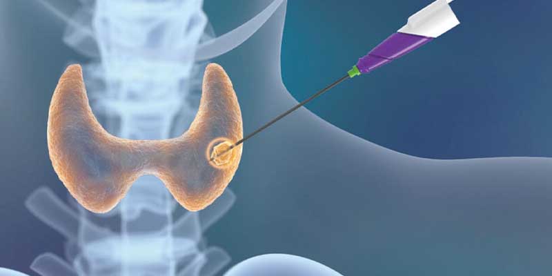 ابلیشن با فرکانس رادیویی تیروئید چیست؟