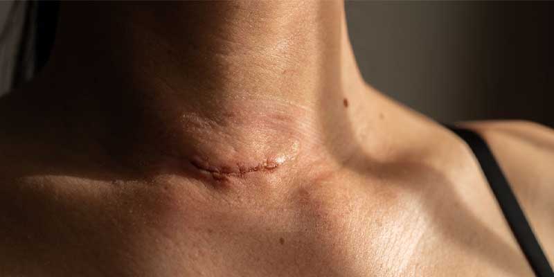 متاستاز سرطان تیروئید چیست؟ از علت تا درمان عود مجدد سرطان تیروئید