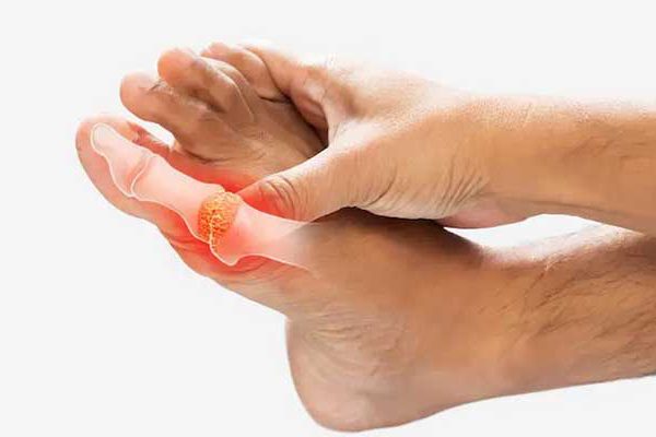 نقرس و کم کاری تیروئید از تشخیص تا درمان