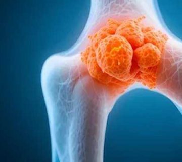 متاستاز سرطان تیروئید به استخوان (علائم، نحوه تشخیص و درمان)