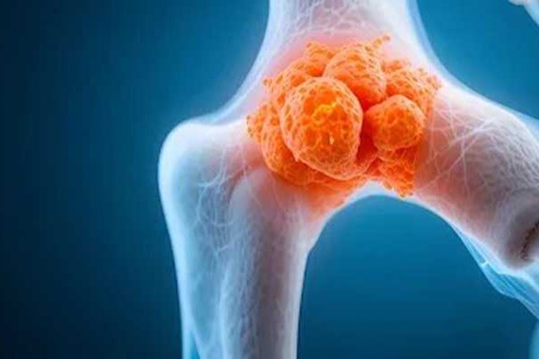 thyroid-cancer-metastasis-to-bone متاستاز سرطان تیروئید به استخوان (علائم، نحوه تشخیص و درمان)