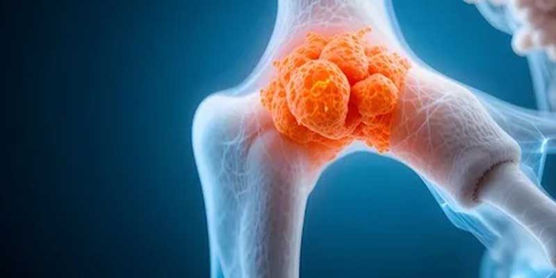 متاستاز سرطان تیروئید به استخوان (علائم، نحوه تشخیص و درمان)